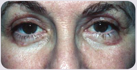 Blepharoplasty POST