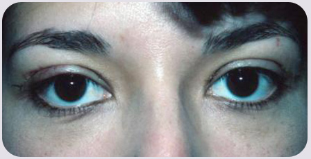 Blepharoplasty Postop