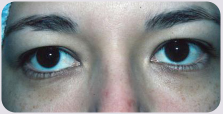 Blepharoplasty Preop