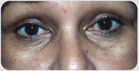 Blepharoplasty Postop