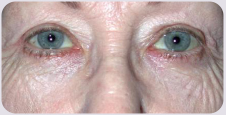 Blepharoplasty Postop