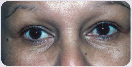 Blepharoplasty Preop