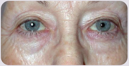 Blepharoplasty Preop