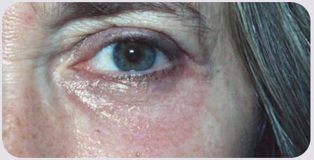 CO2 Laser Resurfacing Postop