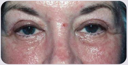 CO2 Laser Resurfacing Postop