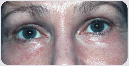 CO2 Laser Resurfacing Postop