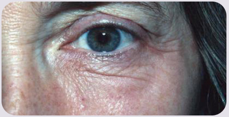 CO2 Laser Resurfacing Preop
