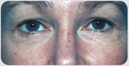 CO2 Laser Resurfacing Preop
