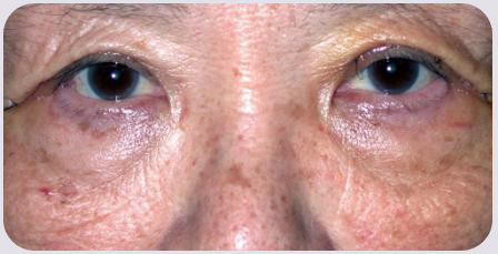 Asian Blepharoplasty Postop