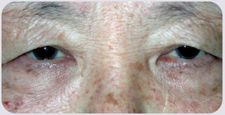 Asian Blepharoplasty Preop