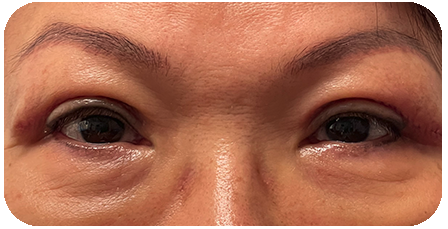 Asian Blepharoplasty Postop