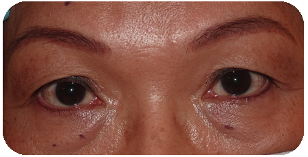 Asian Blepharoplasty Preop